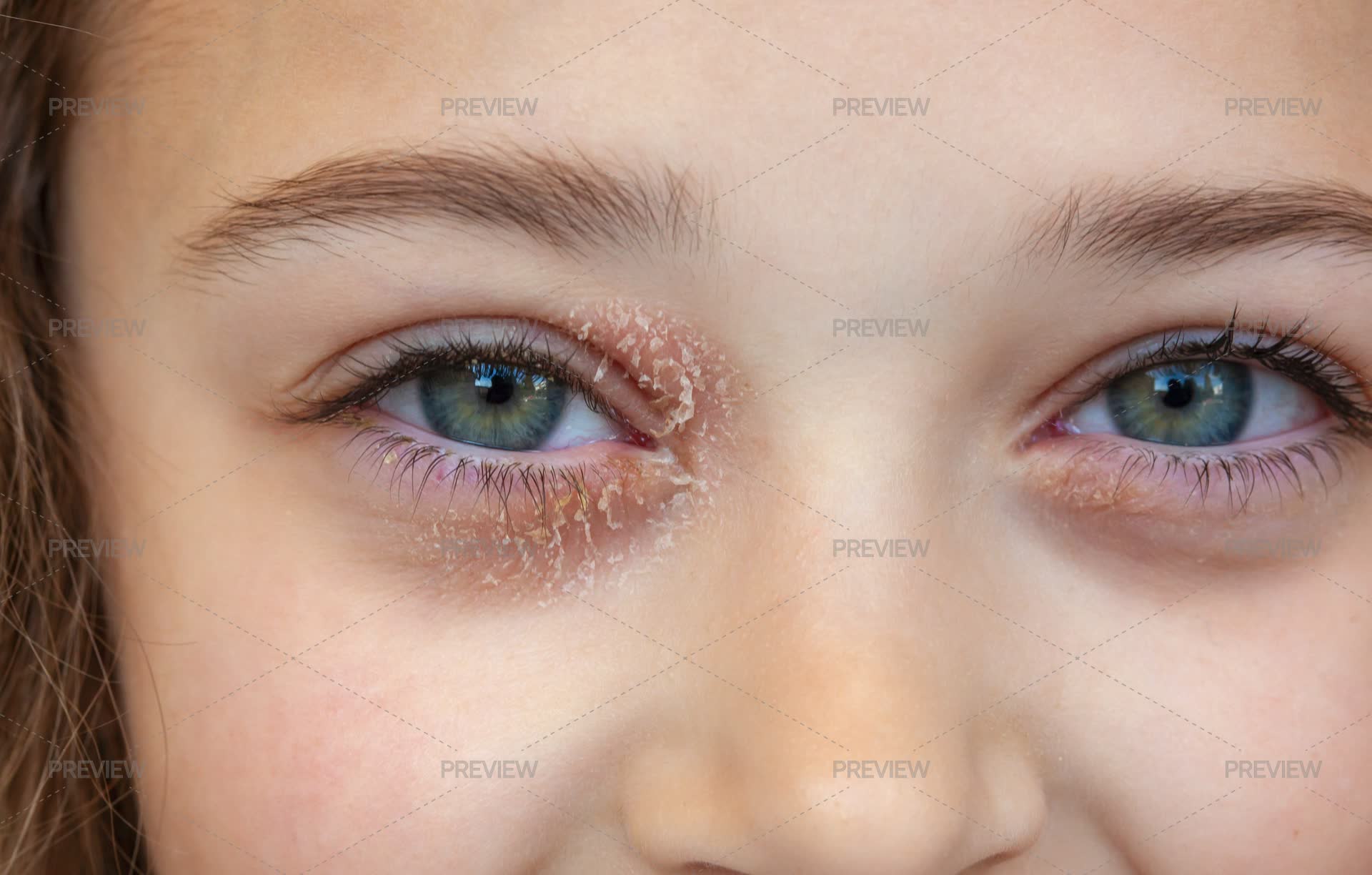 Eye Of A Little Girl Suffering From Ocular Atopic Dermatitis - Stock ...