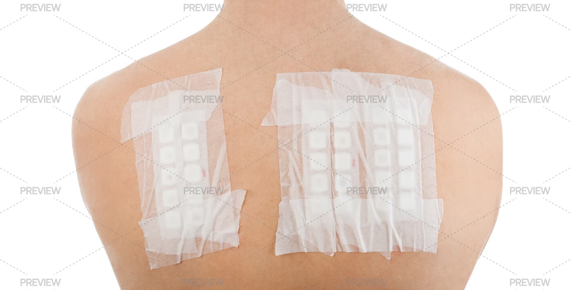 Skin Allergy Patch Test On Back Stock Photos Motion Array skin-allergy-patch-test-on-back-stock-photos-motion-array